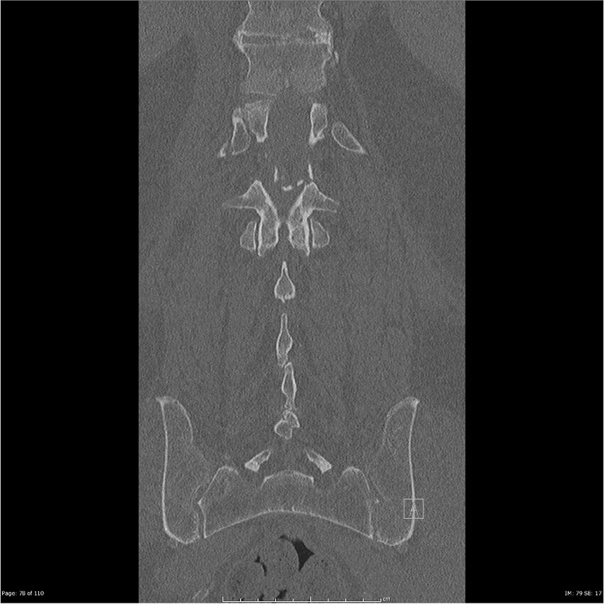 Cardiac trauma (Radiopaedia 32874-33858 Coronal bone window 78).jpg