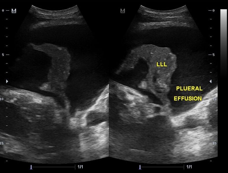 File:Cardiomegaly with bilateral pleural effusion (Radiopaedia 22793-22826 Longitudinal 1).JPG