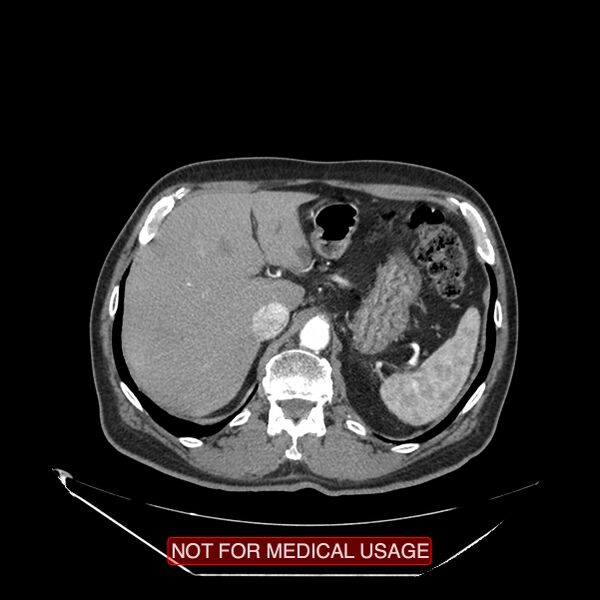 File:Celiac trunk variant anatomy - gastrohepatic trunk and splenic artery (Radiopaedia 38815-40995 A 8).jpg