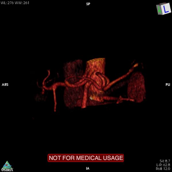 File:Celiac trunk variant anatomy - gastrohepatic trunk and splenic artery (Radiopaedia 38815-40995 B 22).jpg