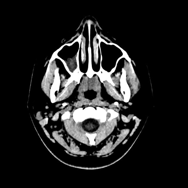 File:Central nervous system Langerhans cell histiocytosis (Radiopaedia 65728-74878 Axial non-contrast 1).jpg