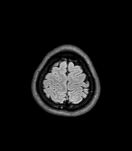 File:Central neurocytoma (Radiopaedia 79320-92380 Axial FLAIR 51).jpg