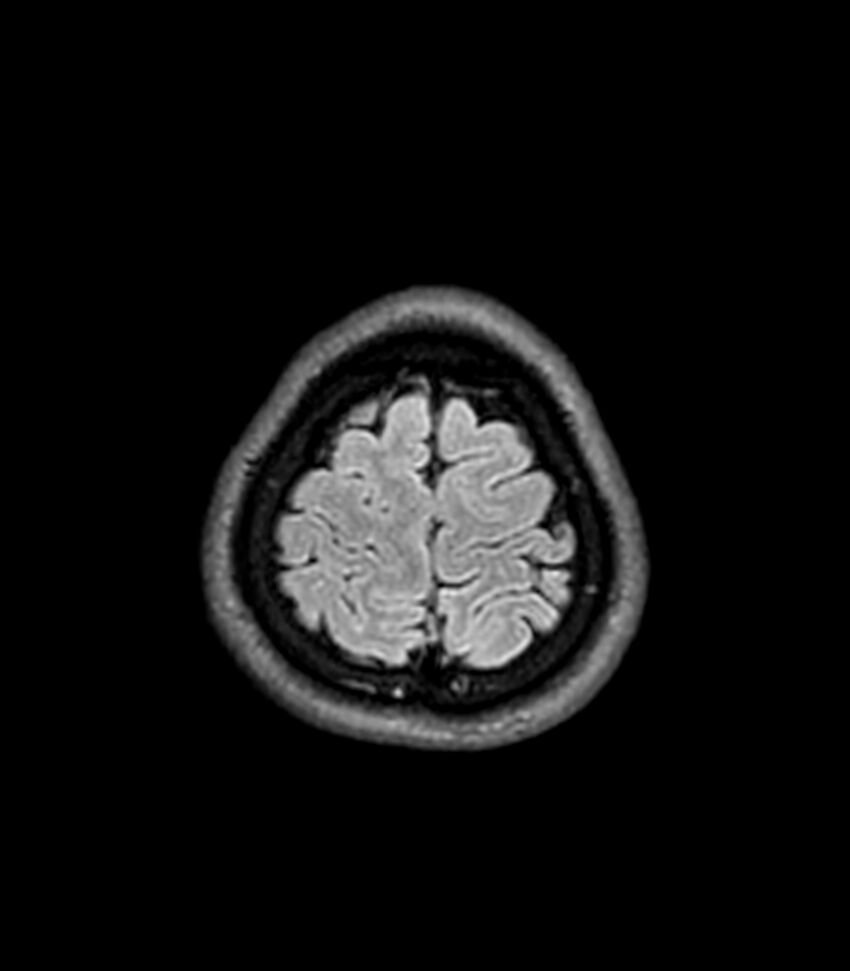 Central neurocytoma (Radiopaedia 79320-92380 Axial FLAIR 51).jpg