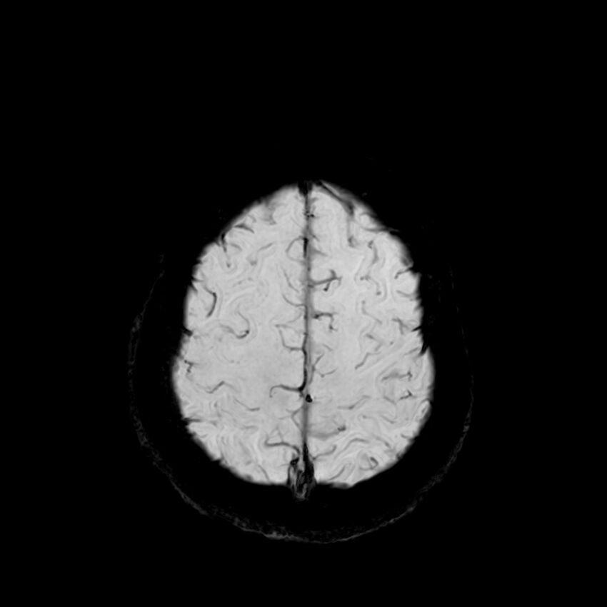 Central neurocytoma (Radiopaedia 79320-92380 Axial SWI 118).jpg