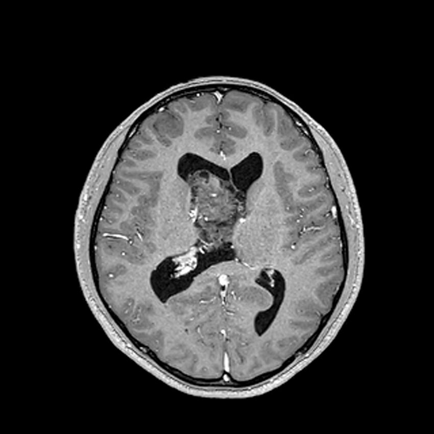 Central neurocytoma (Radiopaedia 79320-92380 Axial T1 C+ 136).jpg