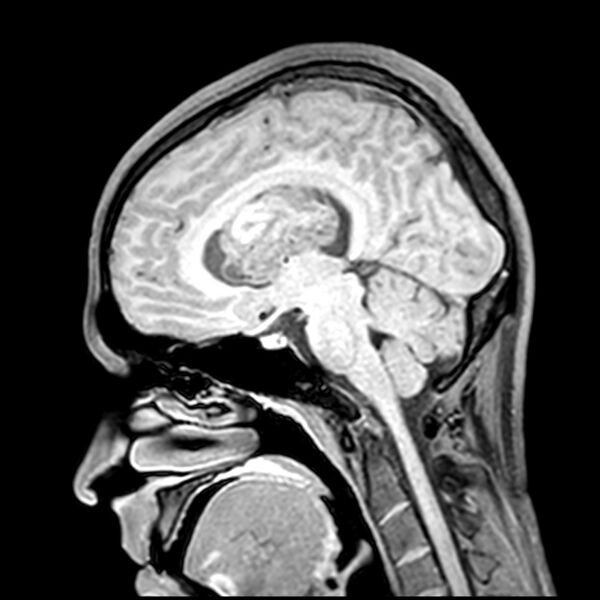 File:Central neurocytoma (Radiopaedia 79320-92380 Sagittal T1 140).jpg
