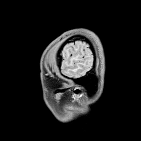 File:Central neurocytoma (Radiopaedia 79320-92380 Sagittal T1 238).jpg