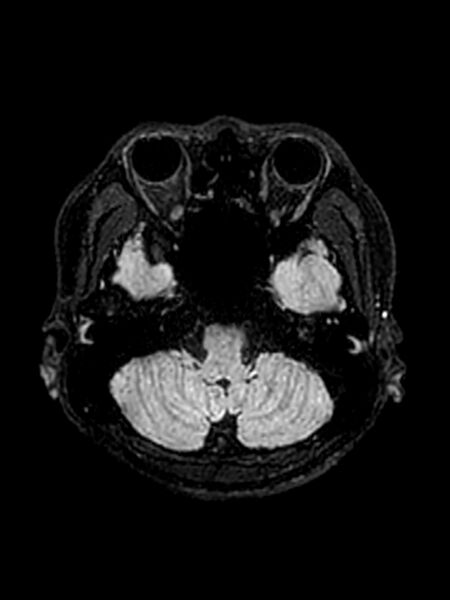 File:Central neurocytoma (Radiopaedia 79320-92381 Axial FLAIR 128).jpg