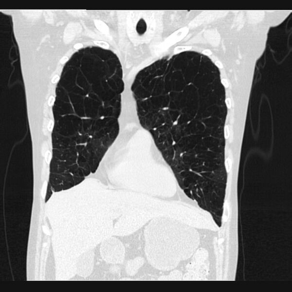 File:Centrilobular pulmonary emphysema (Radiopaedia 24495-24789 Coronal lung window 19).jpg