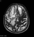 Cerebral abscesses secondary to contusions (Radiopaedia 5201-6968 Axial T2 8).jpg
