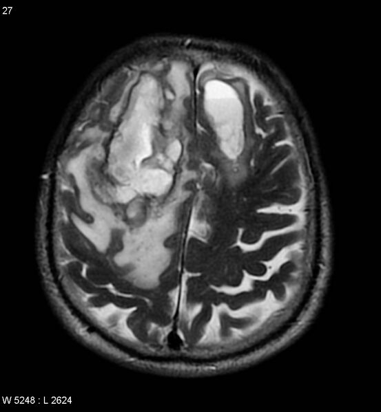 File:Cerebral abscesses secondary to contusions (Radiopaedia 5201-6968 Axial T2 8).jpg