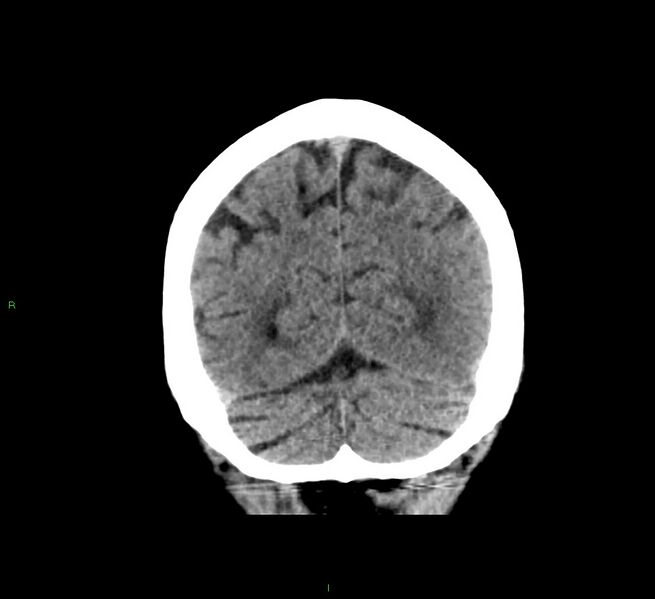 File:Cerebral amyloid angiopathy-associated lobar intracerebral hemorrhage (Radiopaedia 58376-65511 Coronal non-contrast 16).jpg