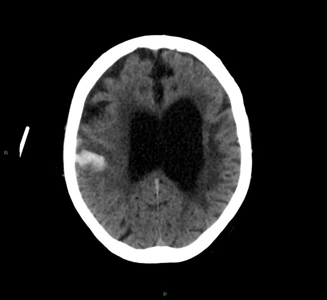 File:Cerebral amyloid angiopathy-associated lobar intracerebral hemorrhage (Radiopaedia 58376-65513 Axial non-contrast 20).jpg