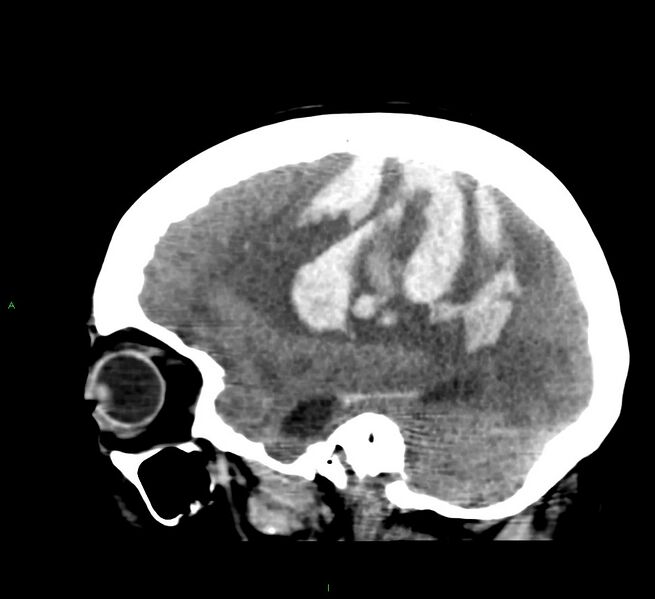File:Cerebral amyloid angiopathy-associated lobar intracerebral hemorrhage (Radiopaedia 58379-65519 C 17).jpg