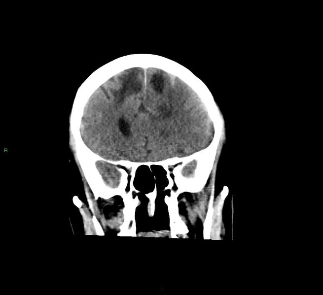 File:Cerebral amyloid angiopathy-associated lobar intracerebral hemorrhage (Radiopaedia 58529-65681 Coronal non-contrast 47).jpg