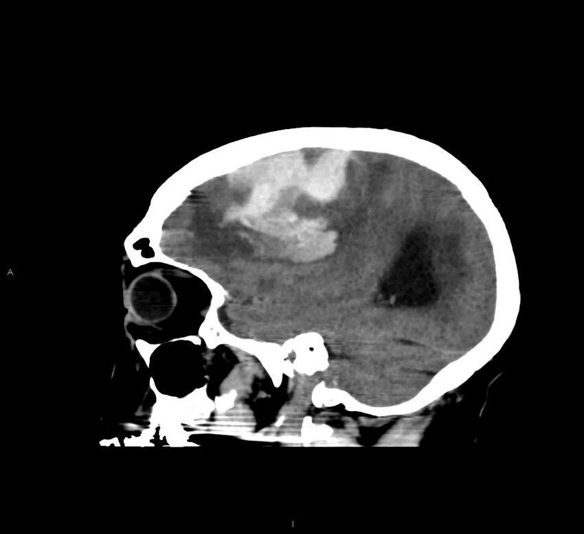 Cerebral amyloid angiopathy-associated lobar intracerebral hemorrhage (Radiopaedia 58560-65723 C 16).jpg