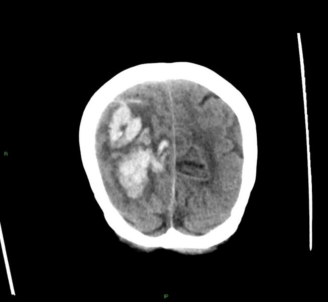 File:Cerebral amyloid angiopathy-associated lobar intracerebral hemorrhage (Radiopaedia 58563-65727 Coronal non-contrast 15).jpg