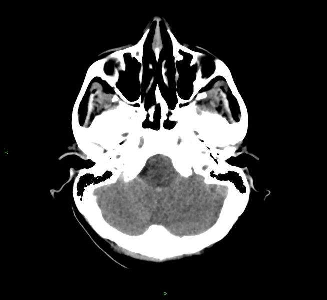File:Cerebral amyloid angiopathy-associated lobar intracerebral hemorrhage (Radiopaedia 58566-65730 Axial non-contrast 42).jpg