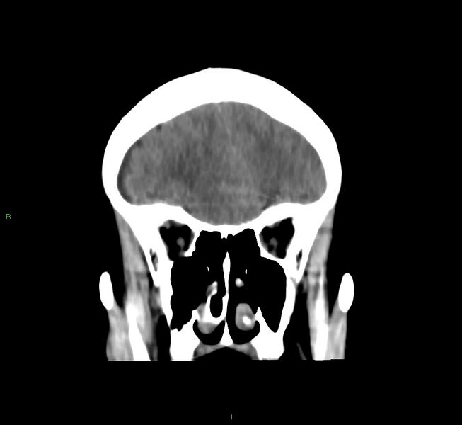 File:Cerebral amyloid angiopathy-associated lobar intracerebral hemorrhage (Radiopaedia 58751-65972 Coronal non-contrast 47).jpg