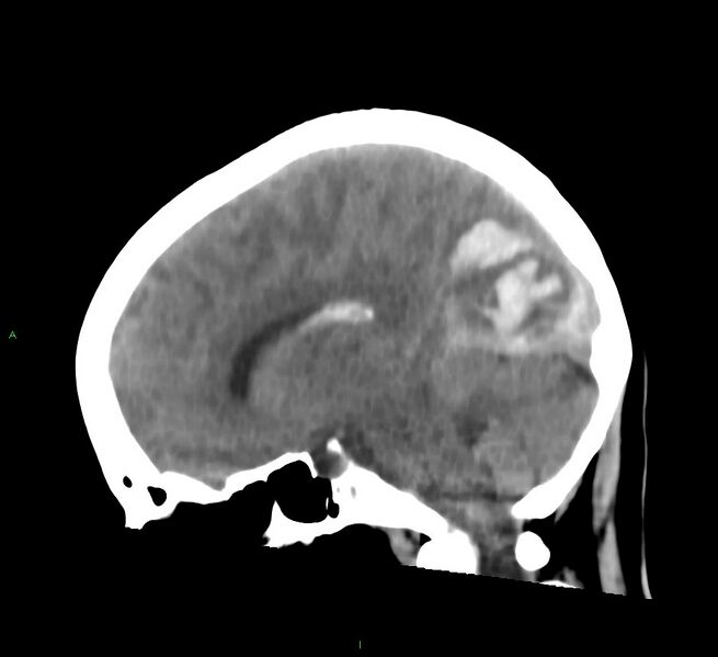 File:Cerebral amyloid angiopathy-associated lobar intracerebral hemorrhage (Radiopaedia 58754-65975 C 26).jpg