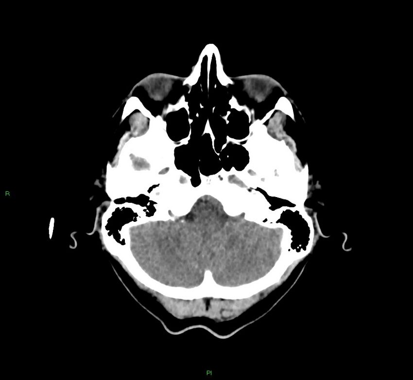 Cerebral amyloid angiopathy-associated lobar intracerebral hemorrhage (Radiopaedia 58756-65977 Axial non-contrast 43).jpg