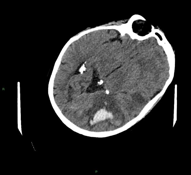 File:Cerebral amyloid angiopathy-associated lobar intracerebral hemorrhage (Radiopaedia 58757-65979 Axial non-contrast 50).jpg
