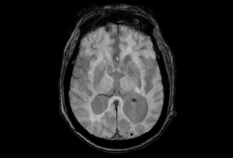 File:Cerebral amyloid angiopathy (Radiopaedia 86671-102792 Axial Gradient Echo 27).jpg