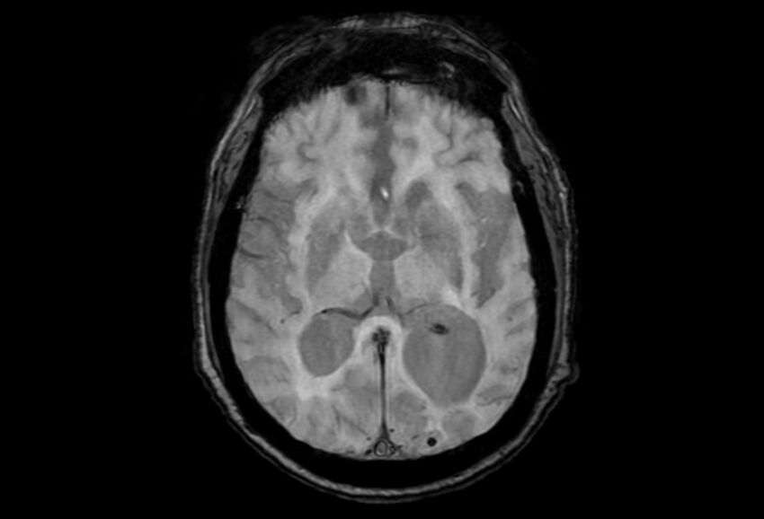 Cerebral amyloid angiopathy (Radiopaedia 86671-102792 Axial Gradient Echo 27).jpg