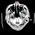 Cerebral and orbital tuberculomas (Radiopaedia 13308-13310 B 2).jpg