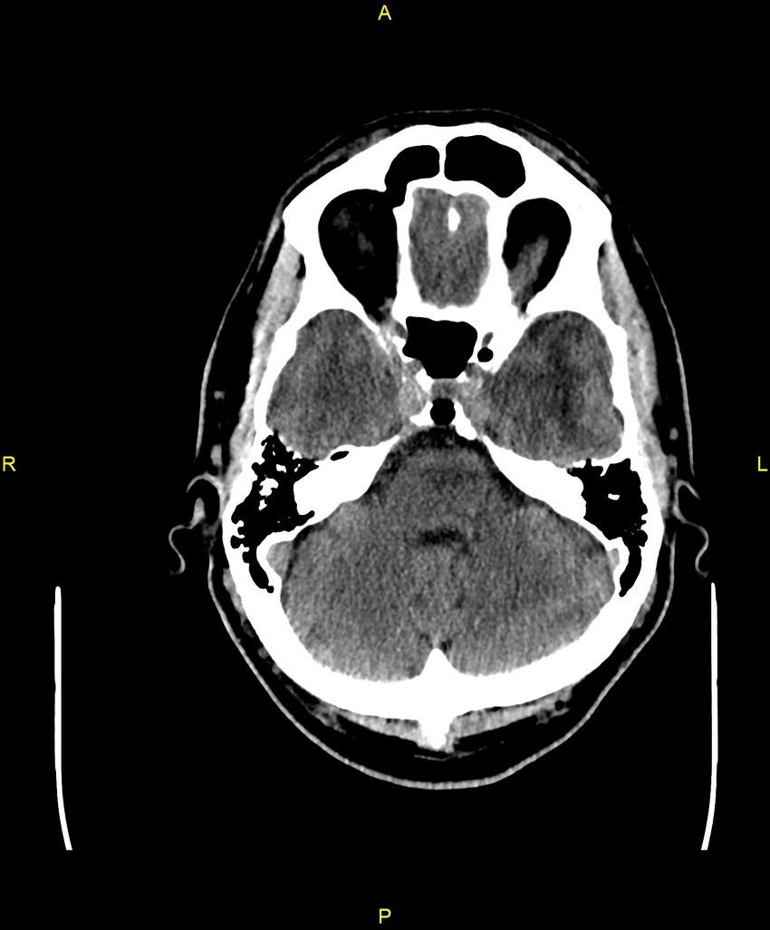 Cerebral autosomal dominant arteriopathy with subcortical infarcts and leukoencephalopathy (CADASIL) (Radiopaedia 86108-102051 Axial non-contrast 27).jpg