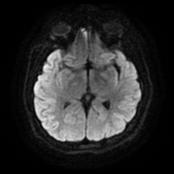 File:Cerebral cavernous malformation (Radiopaedia 44301-47942 Axial DWI 10).jpg