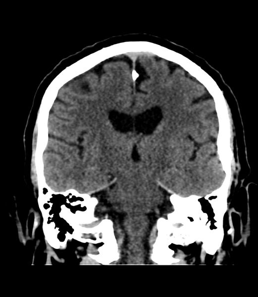 File:Cerebral dural venous sinus thrombosis (Radiopaedia 86514-102575 Coronal non-contrast 27).jpg