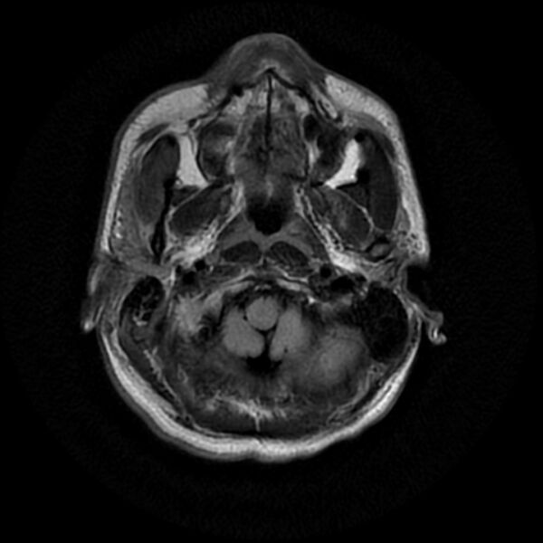 File:Cerebral fat embolism (Radiopaedia 37510-39363 Axial FLAIR 4).jpg