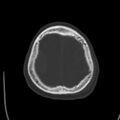 Cerebral hemorrhagic contusions (Radiopaedia 23145-23188 Axial bone window 50).jpg