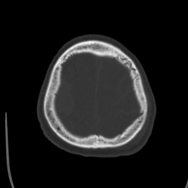 File:Cerebral hemorrhagic contusions (Radiopaedia 23145-23188 Axial bone window 50).jpg