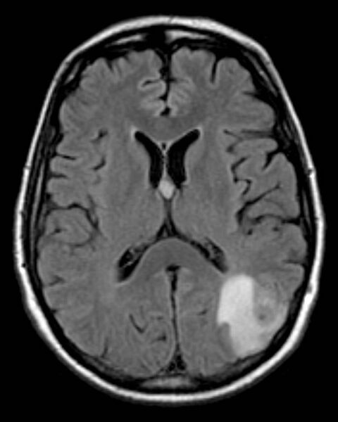 File:Cerebral metastasis - Bull's eye sign (Radiopaedia 2588-6283 Axial FLAIR 1).jpg