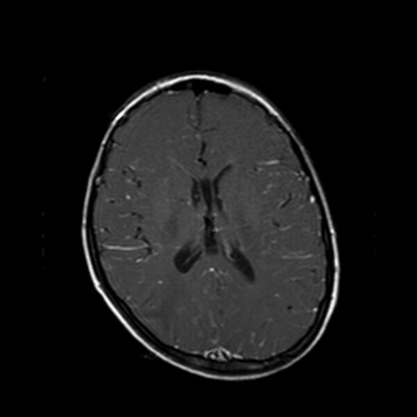 File:Cerebral tuberculoma (Radiopaedia 41152-43932 Axial T1 C+ 13).jpg