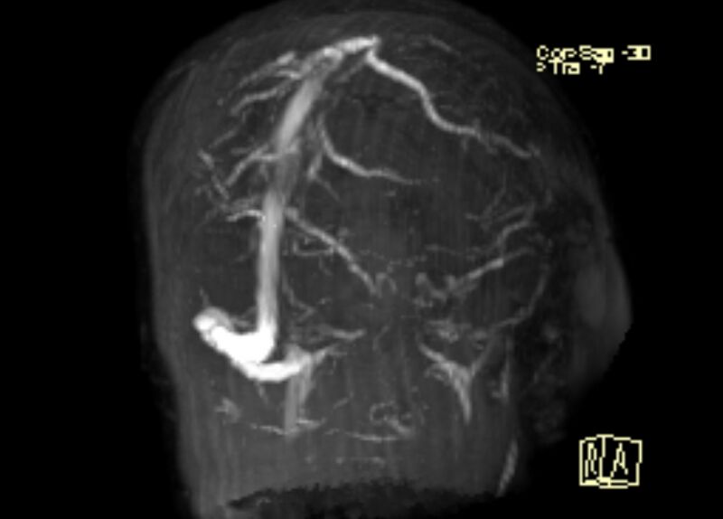 File:Cerebral venous infarct (Radiopaedia 53627-59723 3D MRV 12).jpg