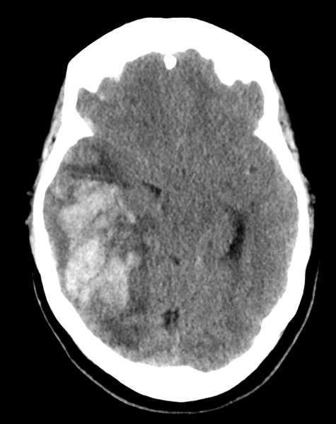 File:Cerebral venous infarct related to dural venous sinus thromboses (Radiopaedia 35292-36803 AXIAL THICK 11).png