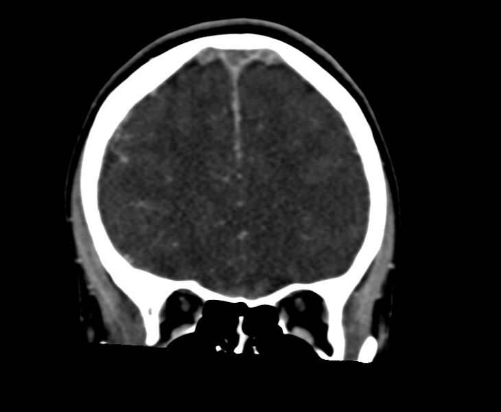 File:Cerebral venous sinus thrombosis (Radiopaedia 59224-66646 Coronal C+ delayed 20).jpg