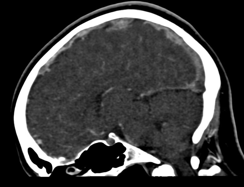 File:Cerebral venous sinus thrombosis (Radiopaedia 59224-66646 Sagittal C+ delayed 28).jpg