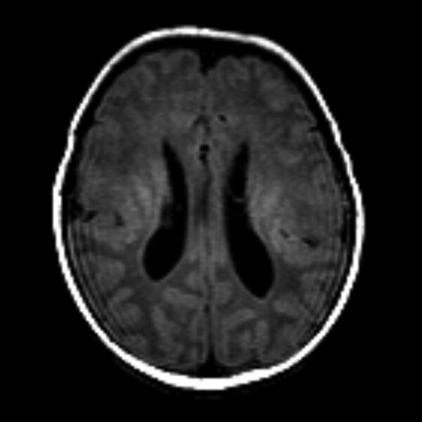File:Cerebrohepatorenal syndrome (Zellweger syndrome) (Radiopaedia 8346-9187 Axial T1 1).jpg