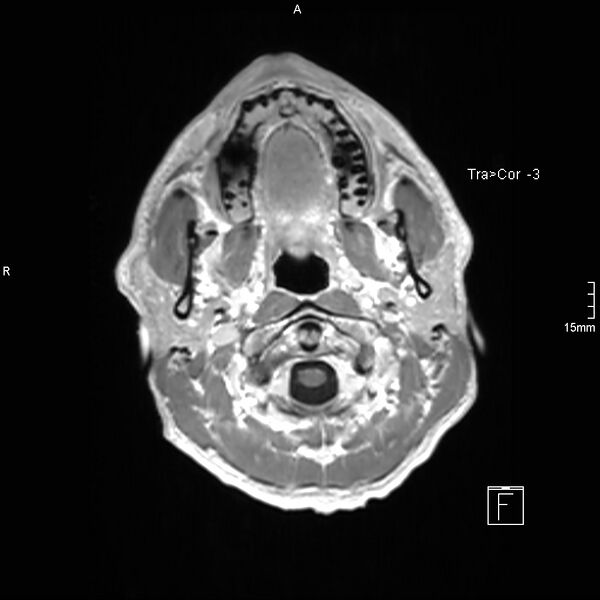 File:Cervical dural CSF leak on MRI and CT treated by blood patch (Radiopaedia 49748-54995 Axial T1 C+ 7).jpg