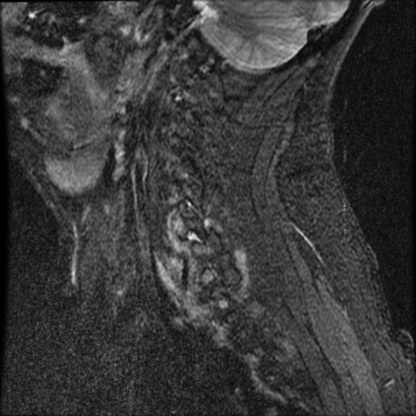 File:Cervical fracture and dislocation with locked facet (Radiopaedia 31837-32781 Sagittal STIR 1).jpg