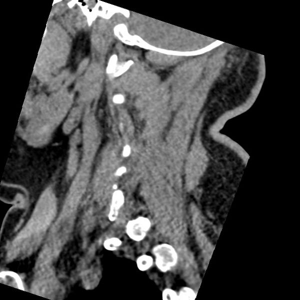 File:Cervical spinal neurofibroma in a patient with NF1 (Radiopaedia 58344-65464 C 11).jpg