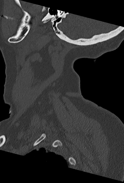 File:Cervical spine ACDF loosening (Radiopaedia 48998-54070 Sagittal bone window 15).png