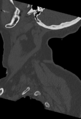 Cervical spine ACDF loosening (Radiopaedia 48998-54070 Sagittal bone window 15).png
