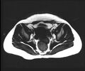 Cesarean section scar endometrioma (Radiopaedia 56569-63297 Axial T1 3).jpg