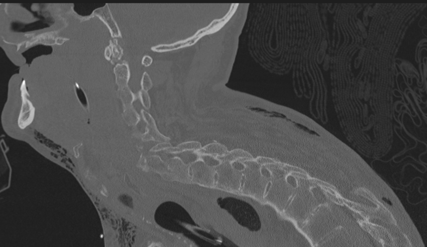 Chalk stick fracture (Radiopaedia 57948-64928 Sagittal bone window 38).png