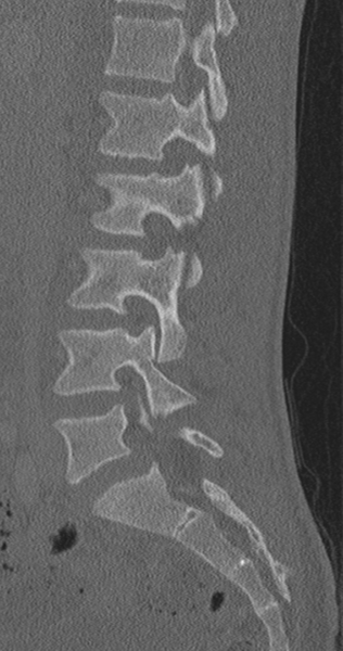 File:Chance fracture (Radiopaedia 40360-42912 Sagittal bone window 59).png